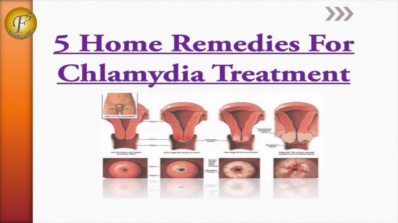 5 HOME REMEDIES FOR CHLAMYDIA TREATMENT II ?  ...
