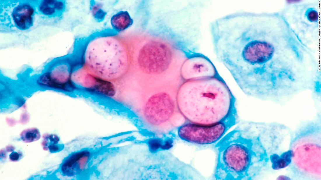 A chlamydia vaccine shows signs of success in an early trial