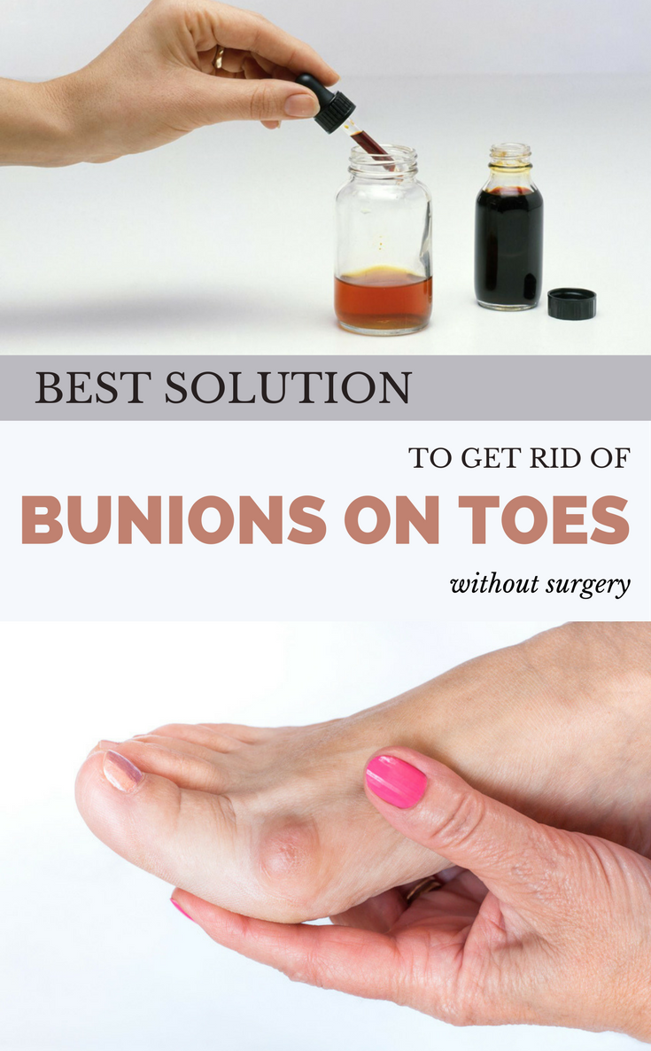 Best Solution to Get Rid of Bunions on Toes Without ...