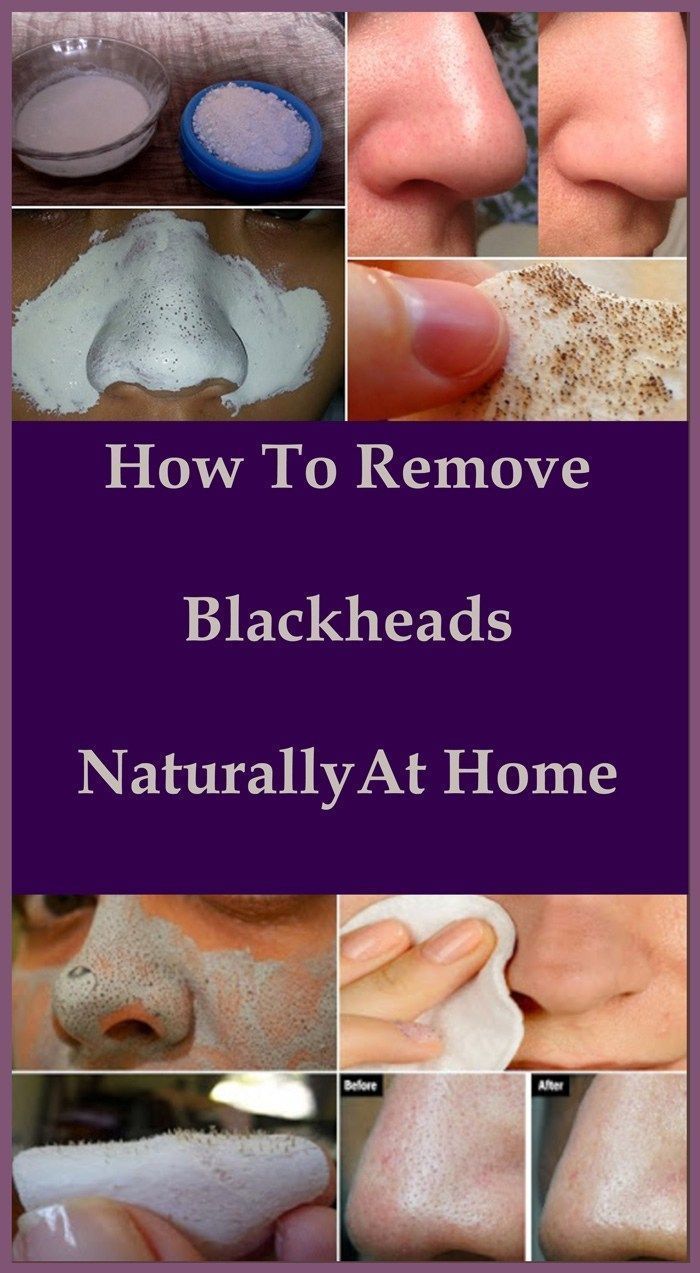 Best way to get rid of blackheads on chin at home in 2020 ...