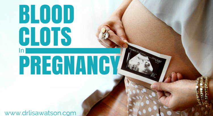 Blood Clots in Pregnancy