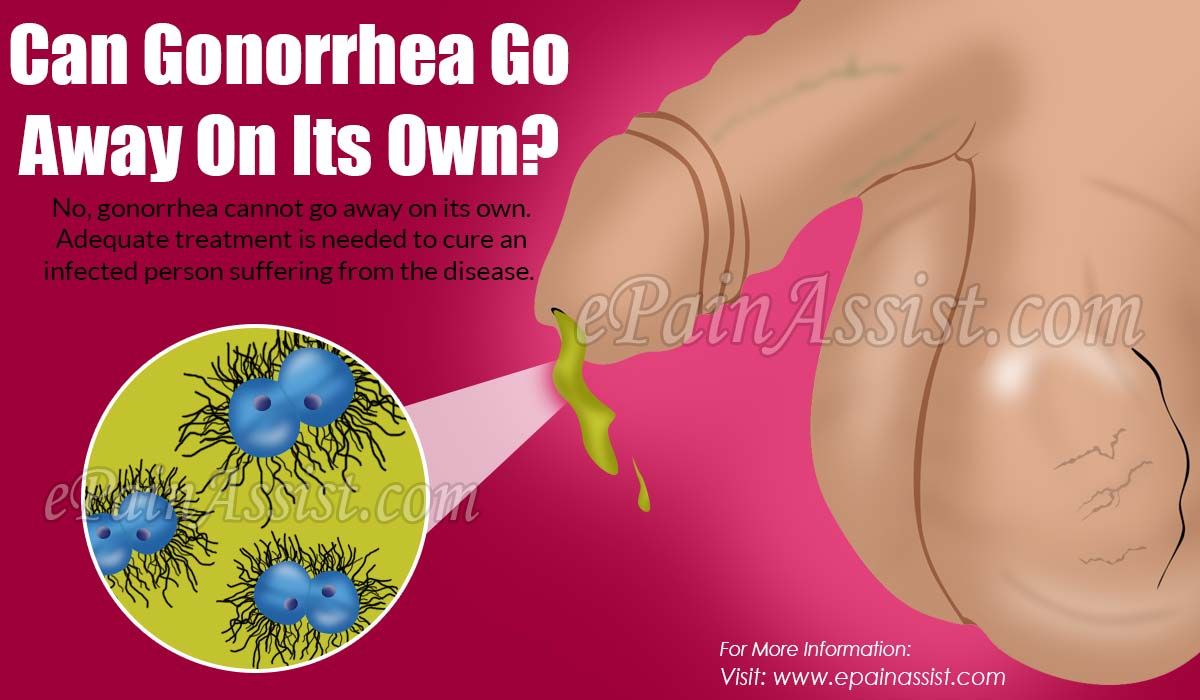 Can Gonorrhea Go Away On Its Own?