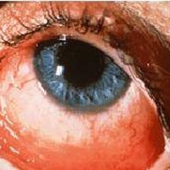 Chlamydia Eye Infection Symptoms