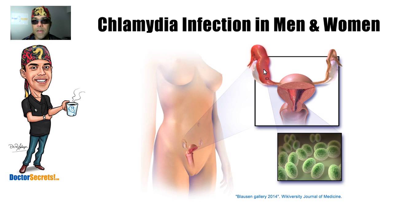 Chlamydia Infection in Men and Women Secrets