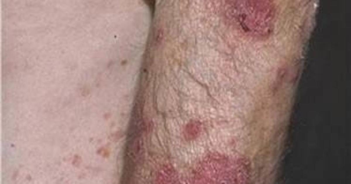 Chlamydia Infection Pictures: What does Chlamydia Symptoms look like