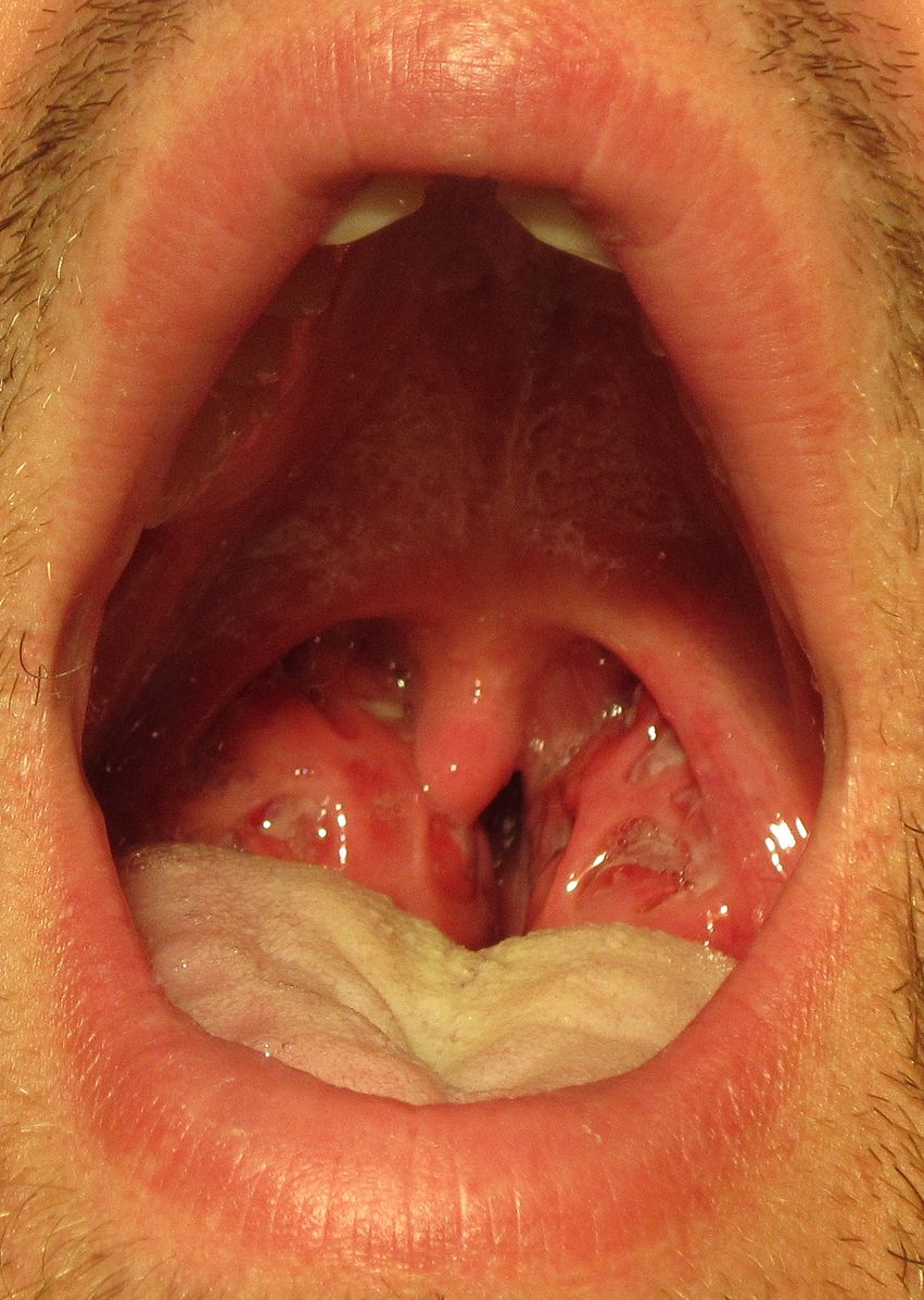Difference Between Chlamydia and Strep Throat