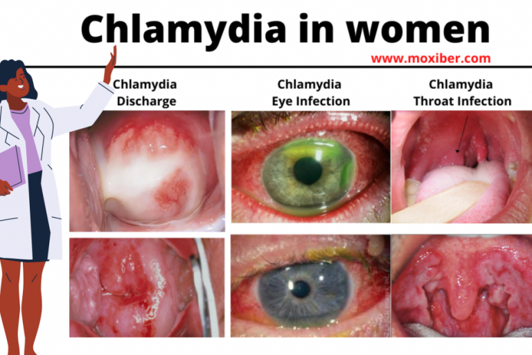 Early Signs Of Chlamydia Female