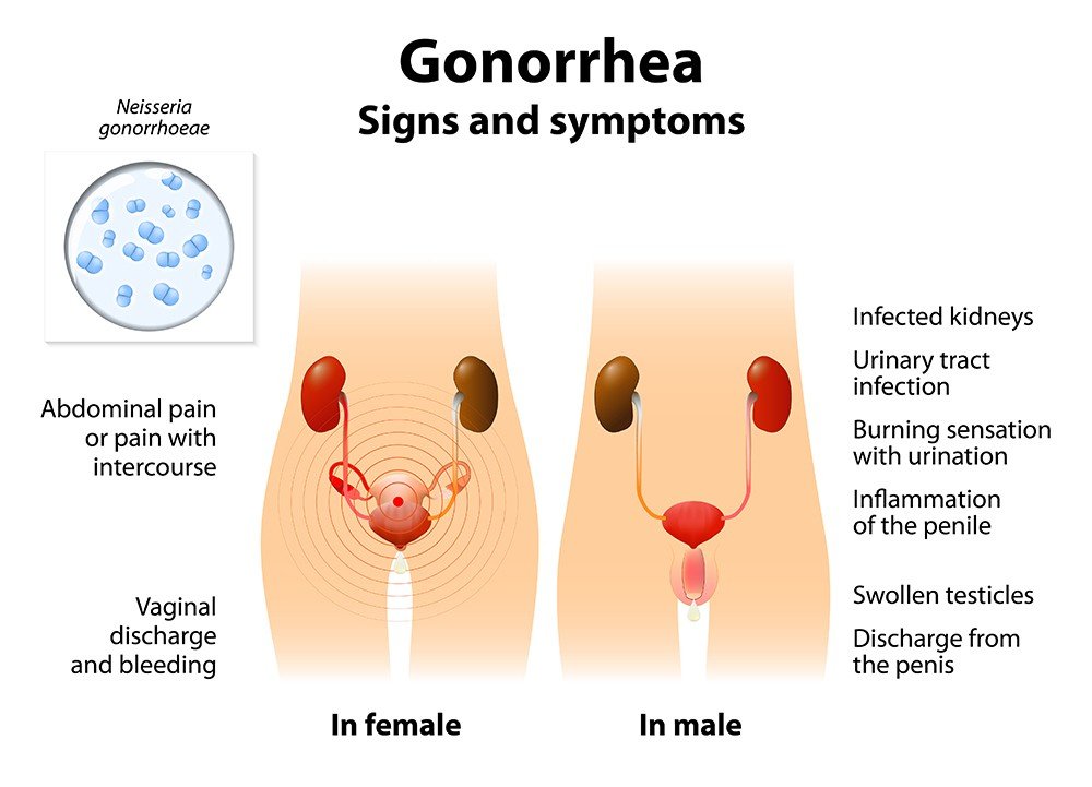 Gonorrhea (the clap) Symptoms, Pictures, Treatment