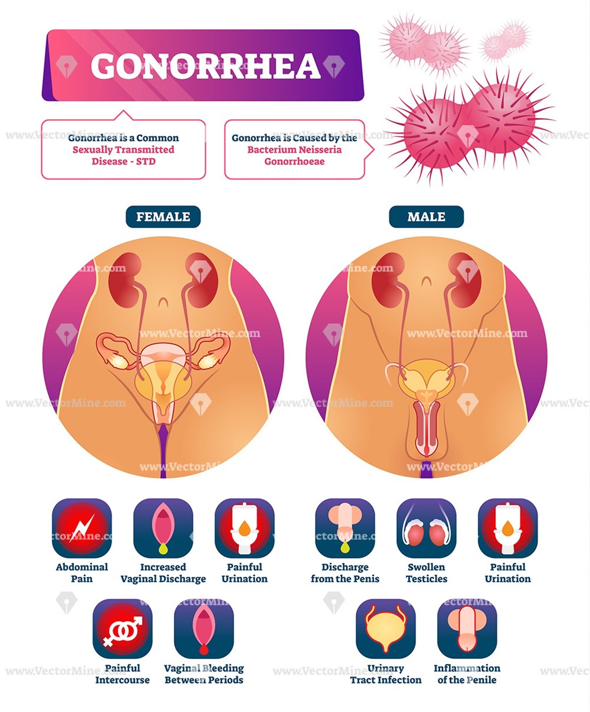 Gonorrhea vector illustration labeled STD disease infographic