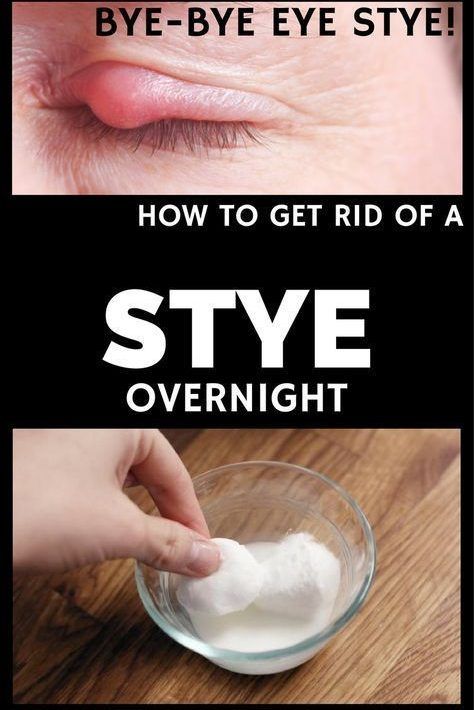How To Get Rid Of A Stye Overnight in 2020