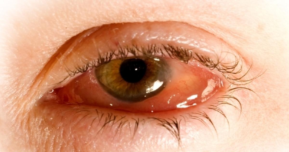 How to get rid of conjunctivitis at home?