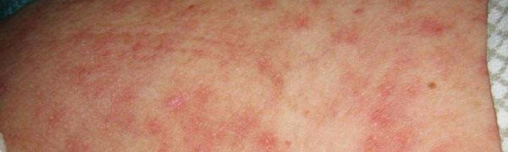 Skin rash and sexually transmitted diseases