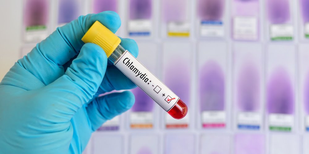 Test options for chlamydia patients