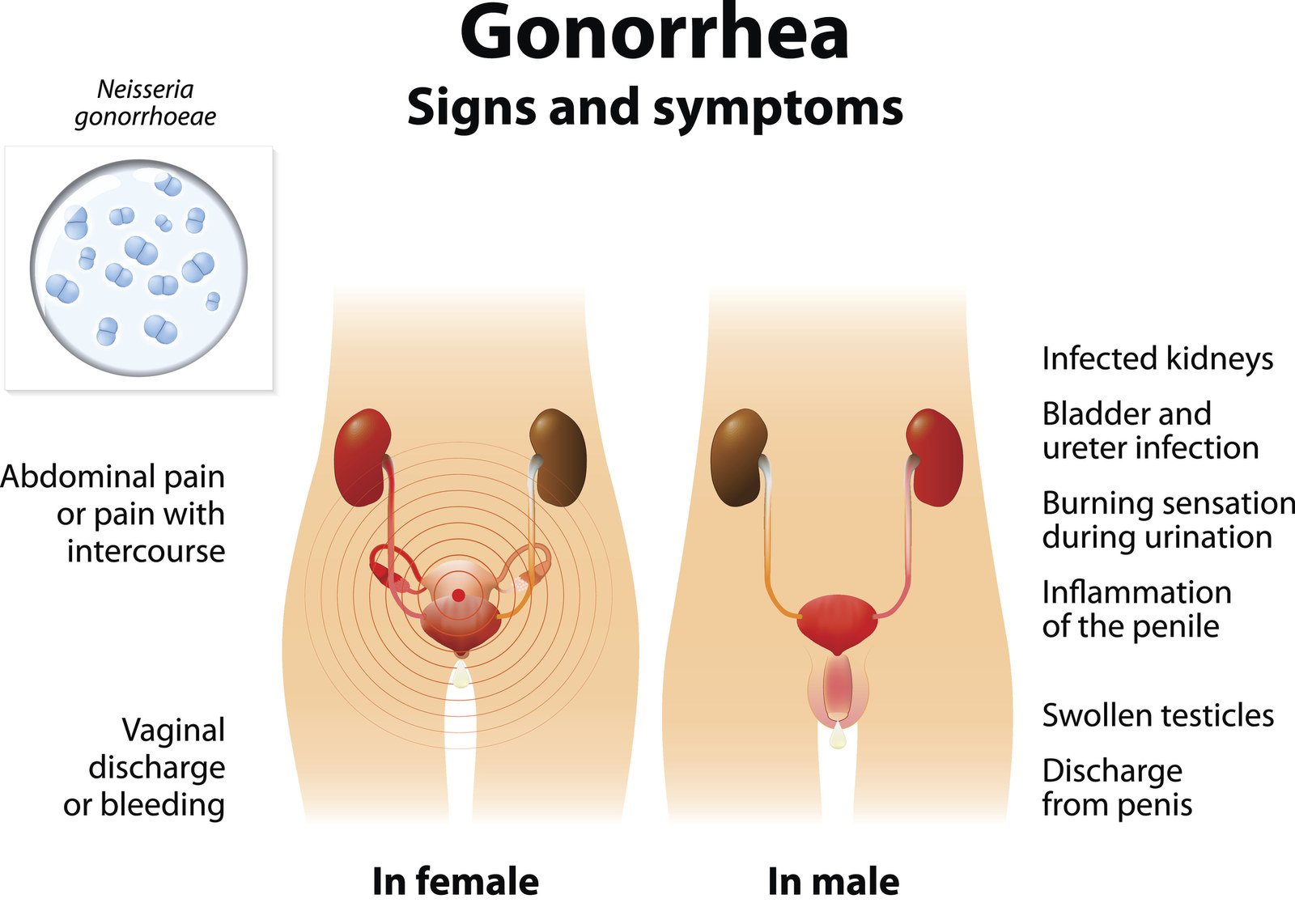 The Man With " Super Gonorrhea"  Was Cured, But Not Everyone In The US Is ...