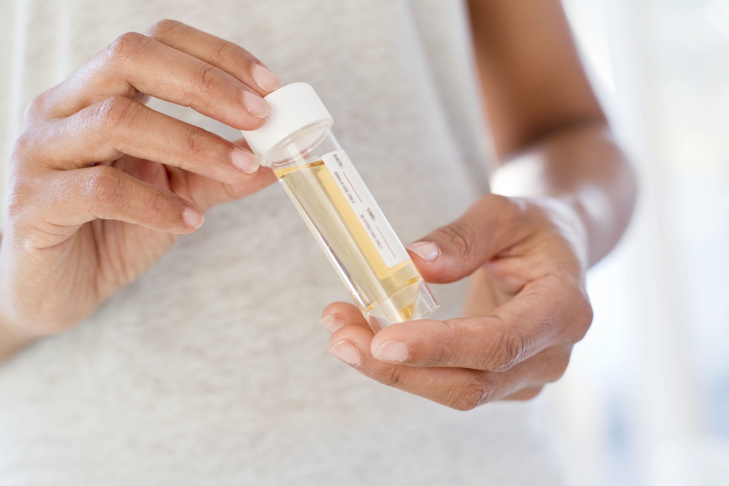 Urine Testing for Sexually Transmitted Diseases