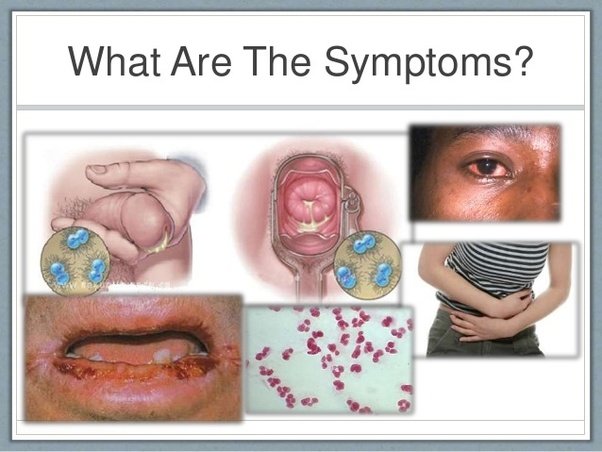 What are the signs of gonorrhea?