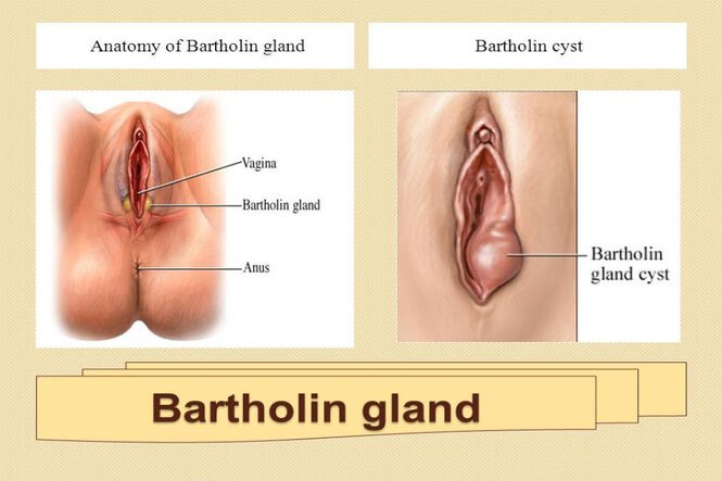 What does a bartholin cyst look like when it bursts ...