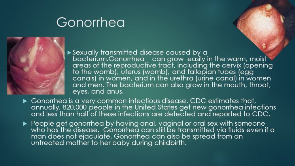 What is Gonorrhea? The Clap Causes, Symptoms &  Treatments ...