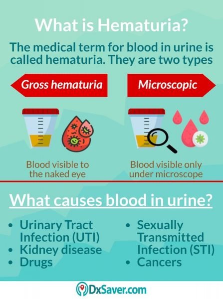 Why Do I See Blood in the Urine? Types of STDs Causing ...